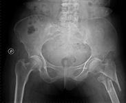 Kalça Kemiği Çatlağı Belirtileri ve Tedavisi