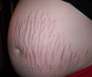 Gebelikte Çatlak Belirtileri ve Tedavisi