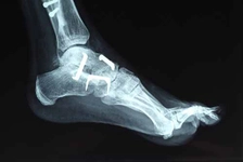 Parmak Çatlağı Belirtileri ve Tedavisi