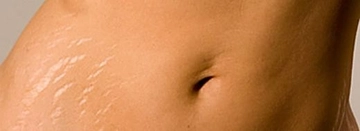 Cilt Çatlakları Belirtileri ve Tedavisi