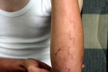 Kolda Çatlak Belirtileri ve Tedavisi