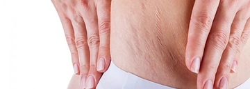 Vücut Çatlakları Belirtileri ve Tedavisi