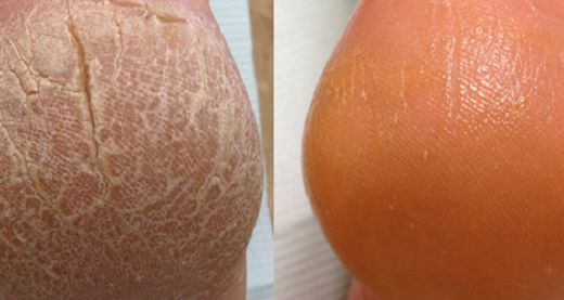 Ayak Çatlağı Belirtileri ve Tedavisi