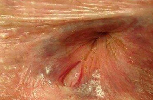 Basur Çatlaklarının Tedavisi