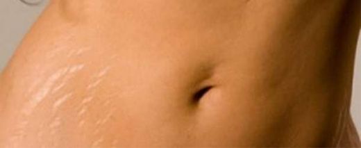 Çatlak İzleri Belirtileri ve Tedavisi