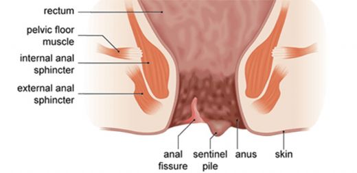 Fissür Çatlak Nedenleri Nelerdir?