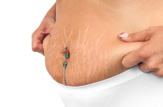 Gebelikte Karın Çatlakları Belirtileri ve Tedavisi