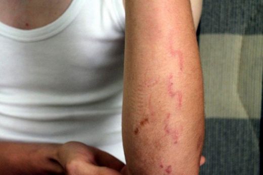 Kolda Çatlak Belirtileri ve Tedavisi