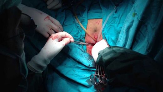 Makat Çatlak Ameliyatı Riskleri ve Sonrası