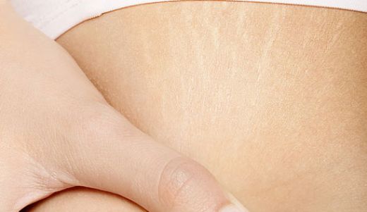 Memede Çatlak Belirtileri ve Tedavisi