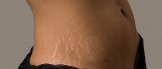 Popoda Çatlak Belirtileri ve Tedavisi