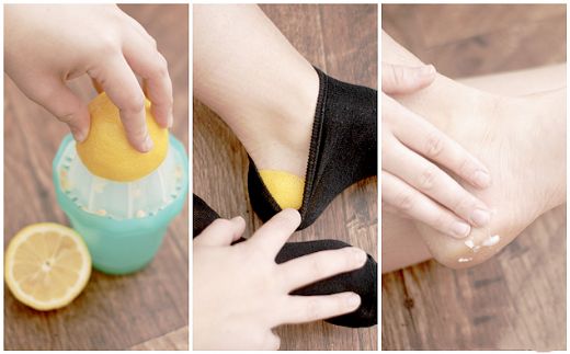 Topuk Çatlağına Ne İyi Gelir?