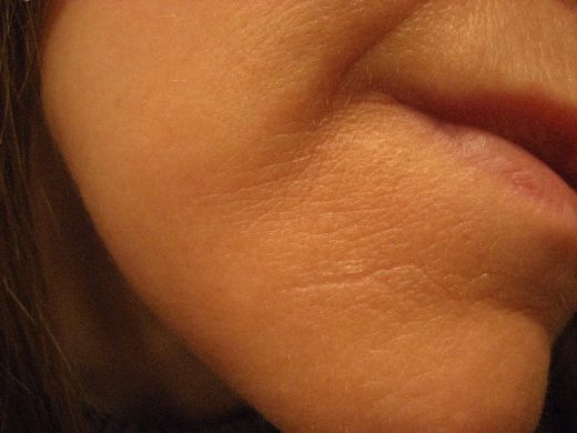 Vücuttaki Çatlaklar Nasıl Gider?