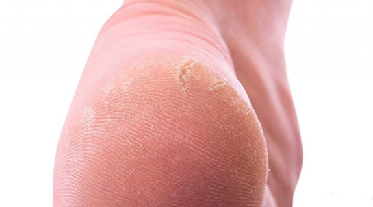 Ayak Çatlaklarına Ne İyi Gelir?