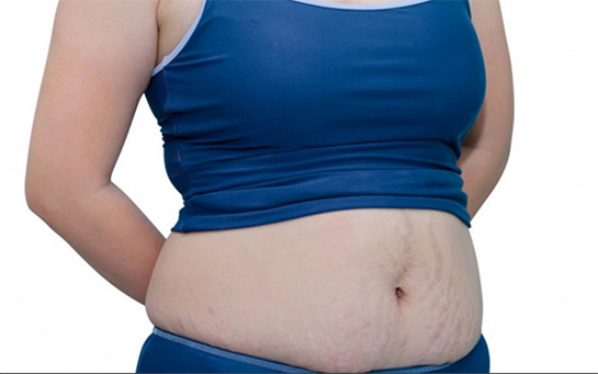 Bağırsak Çatlağı Belirtileri ve Tedavisi