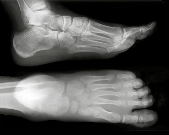 Çatlak Kemik Belirtileri ve Tedavisi