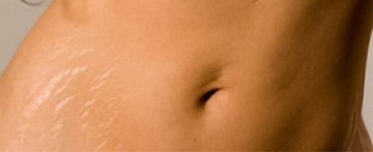 Çatlak Belirtileri ve Tedavisi