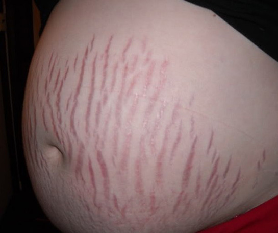 Gebelikte Çatlak Belirtileri ve Tedavisi