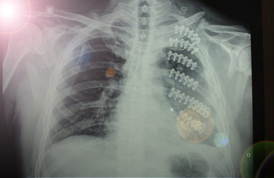 Kaburga Çatlağı Belirtileri ve Tedavisi