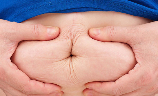 Karın Çatlakları Belirtileri ve Tedavisi